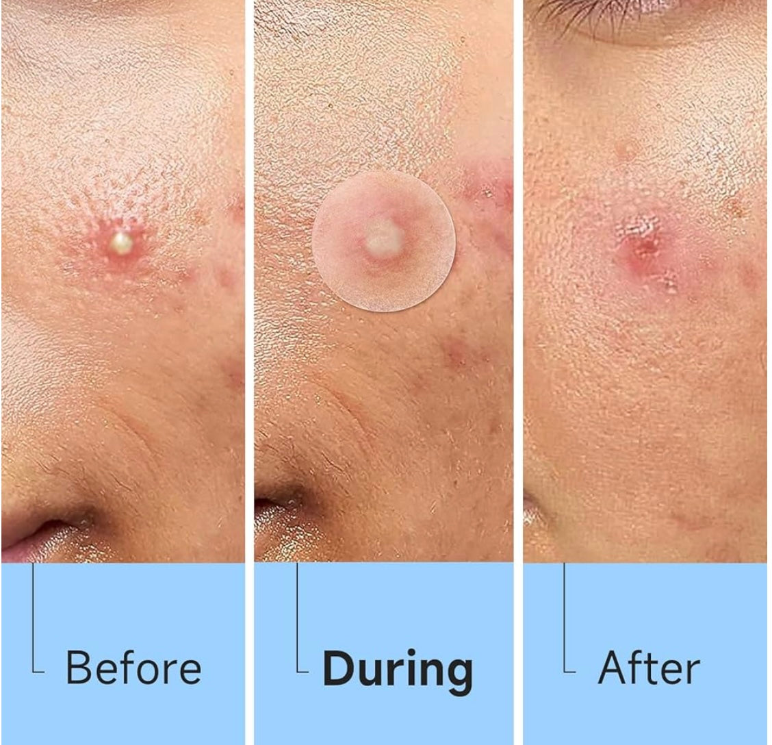 500 clear pimple patches